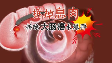 Photo of 【防癌先机专题】拆掉息肉 拆除大肠癌未爆弹